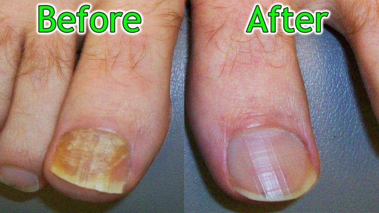 Cabbage For Toe Infection